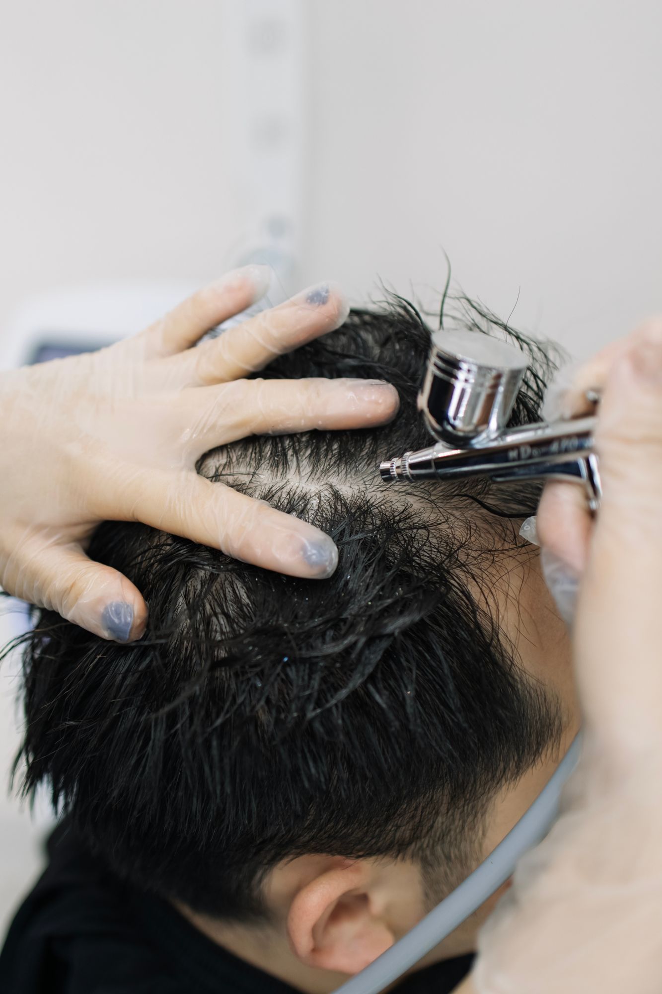 alopecia treatment in Indore
