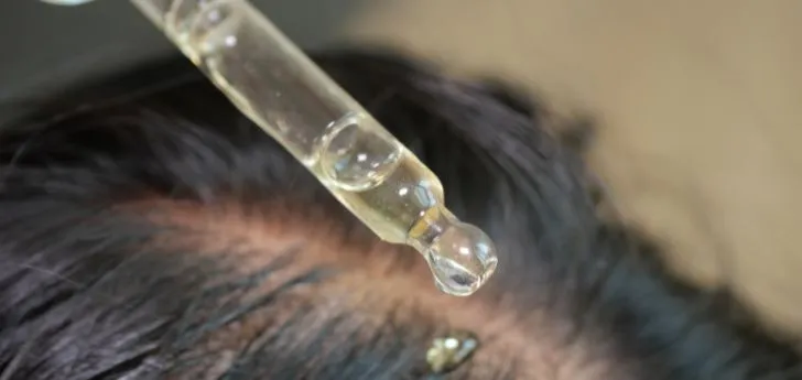 hair loss treatment in Indore