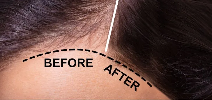 hair clinic in Indore