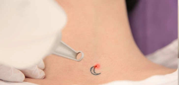 Best Tattoo removal treatment in Indore